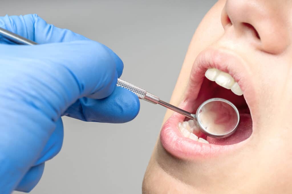 Dentist examining a patient for cavities