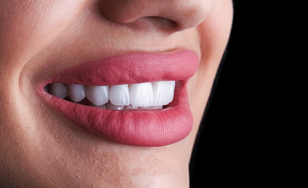 Flawless smile with dental crowns