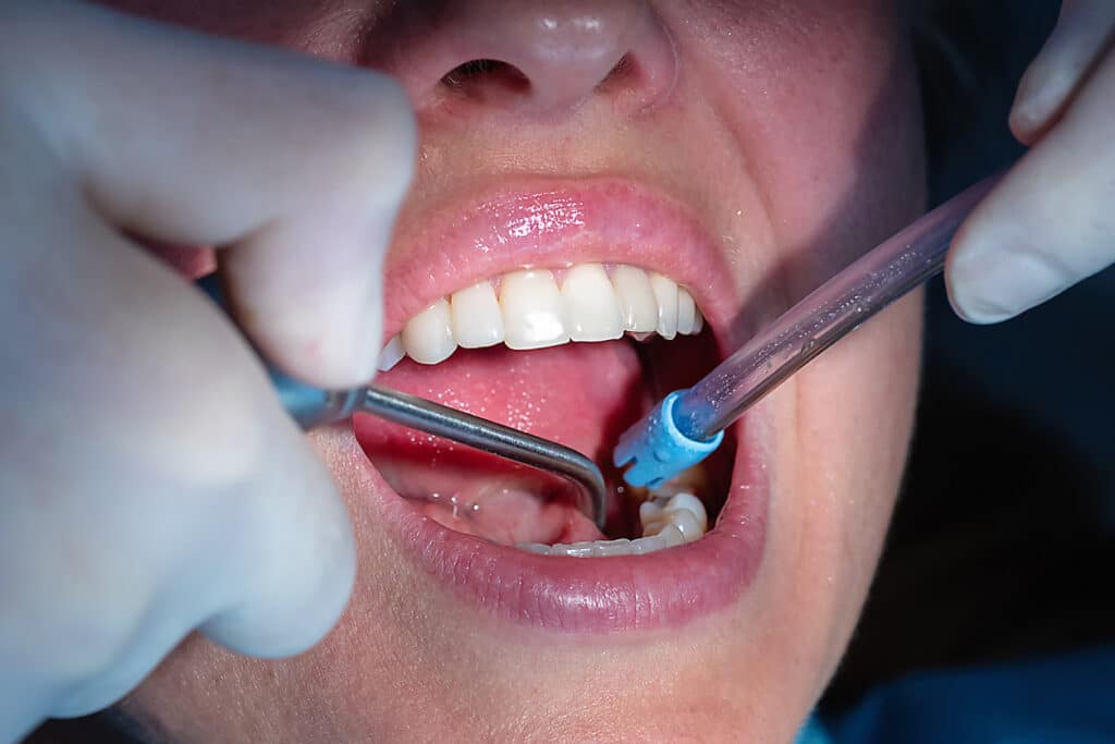 Dental patient witha gentle cleaning